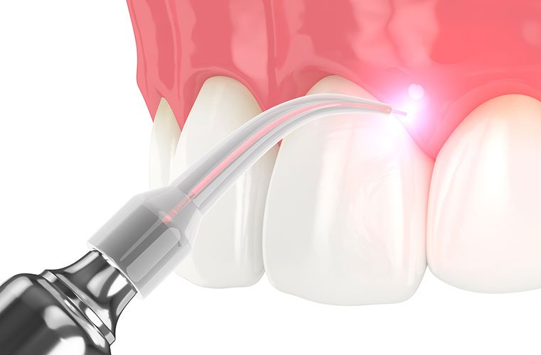 Laser Dentistry
