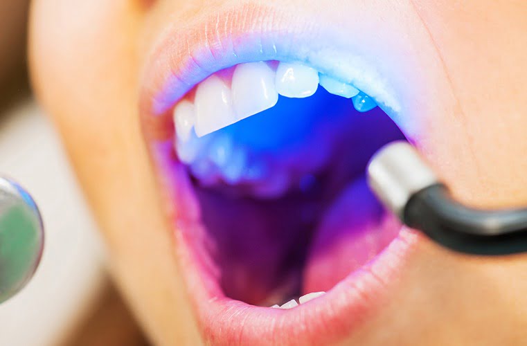 Laser Dentistry