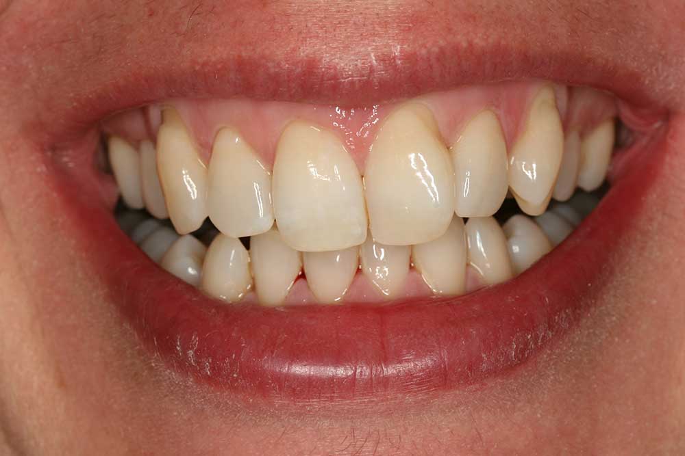 Invisalign