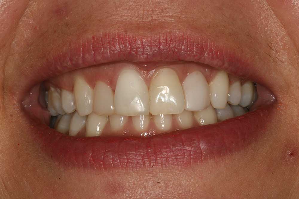 Teeth Whitening
