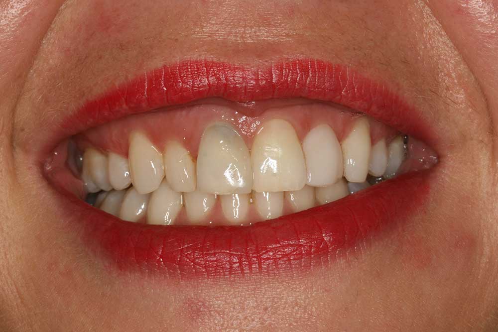 Teeth Whitening