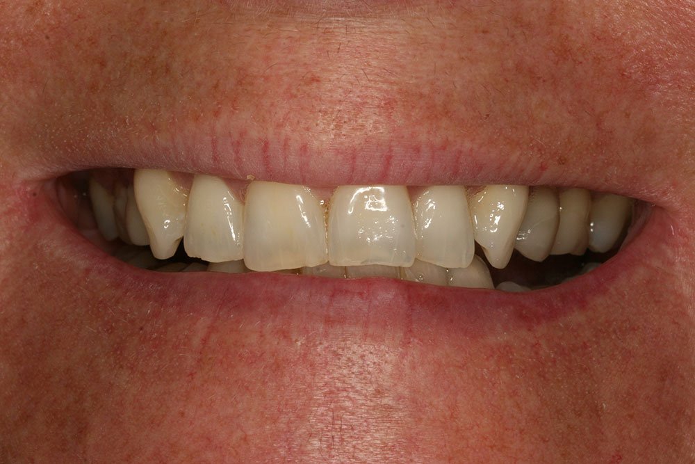 Composite Bonding Before and After