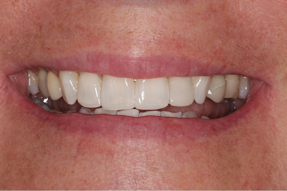 Composite Bonding Before and After