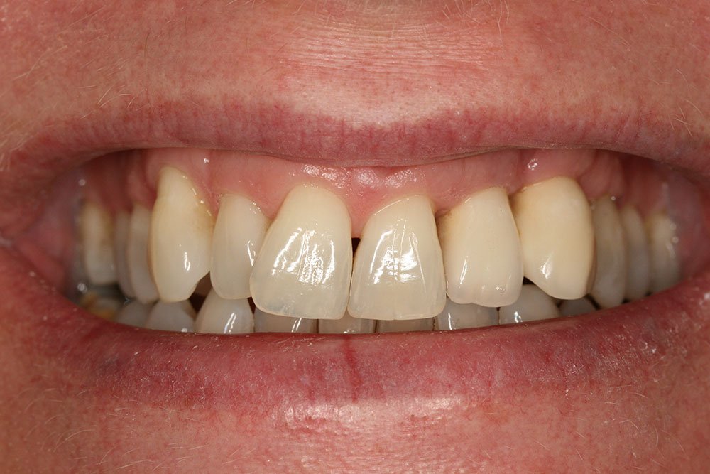 Dental Implants Before and After