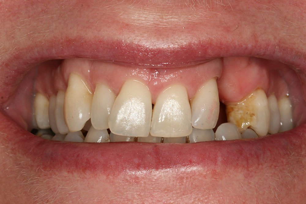 Dental Implants Before and After