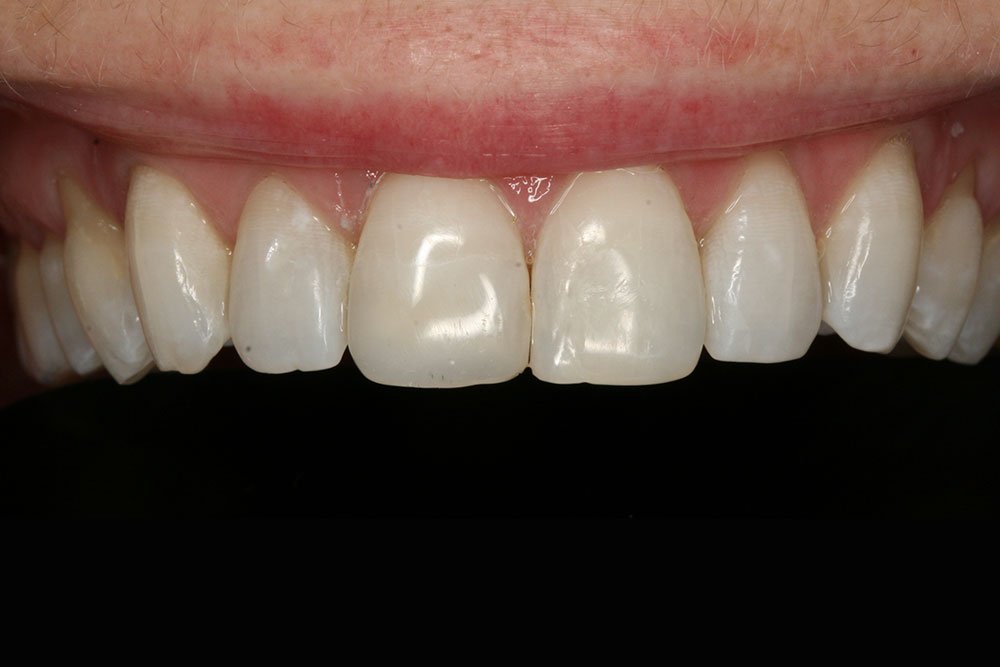 Composite Bonding Before and After