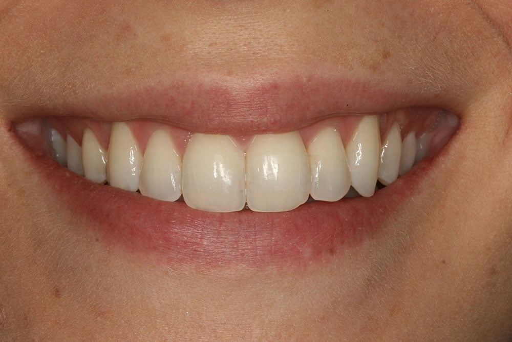 Invisalign Before and After