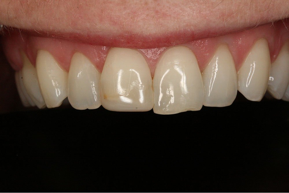 Composite Bonding Before and After