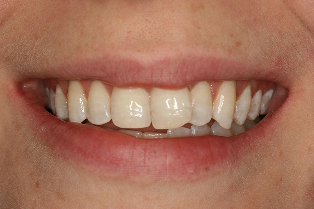 Invisalign Before and After