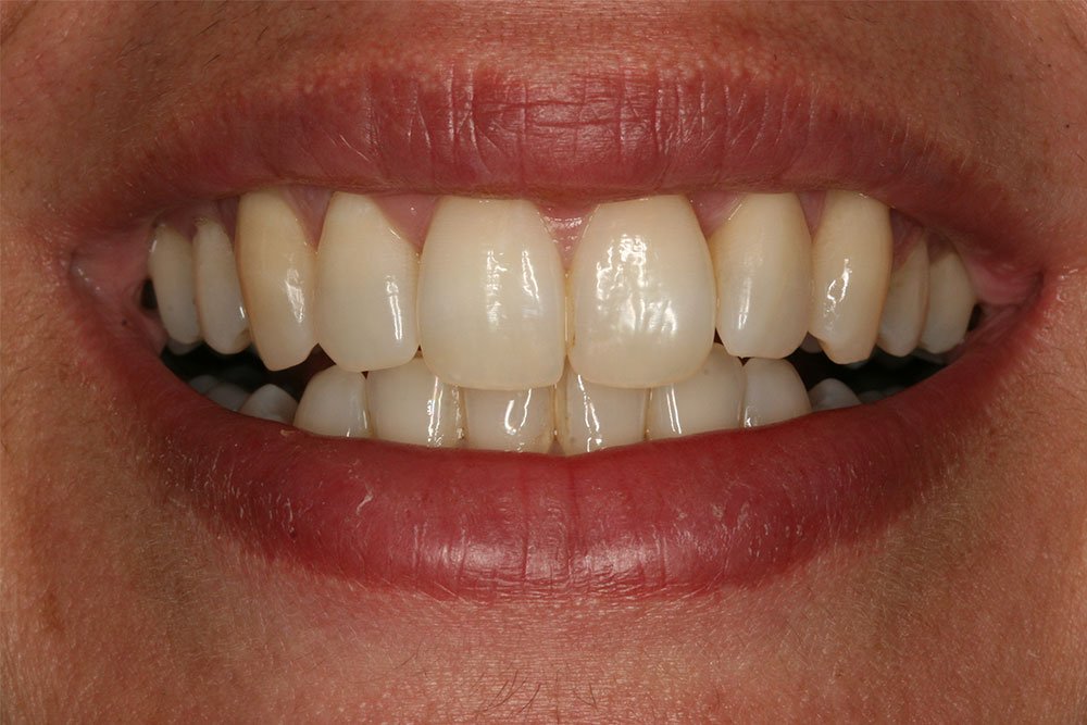 Invisalign Before and After