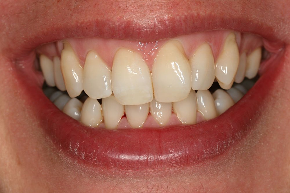 Invisalign Before and After