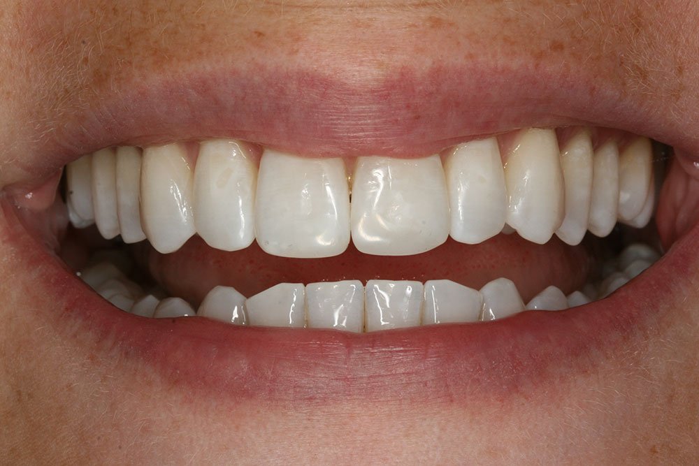 Composite Bonding Before and After