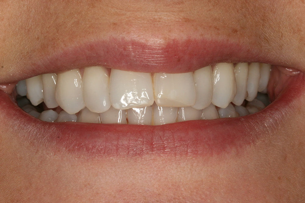 Composite Bonding Before and After