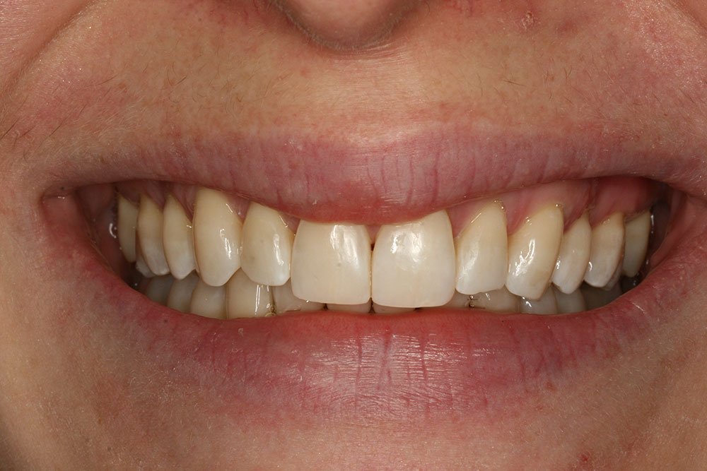 Composite Bonding Before and After
