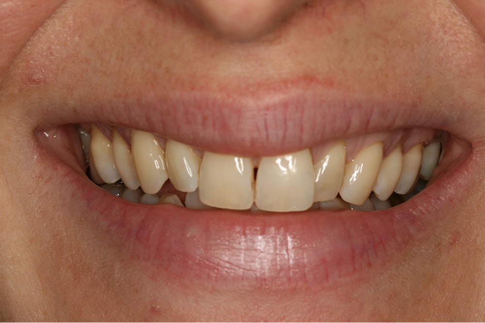 Composite Bonding Before and After