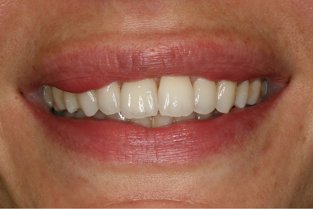 Dental Implants Before and After