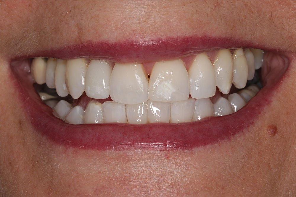 Invisalign Before and After