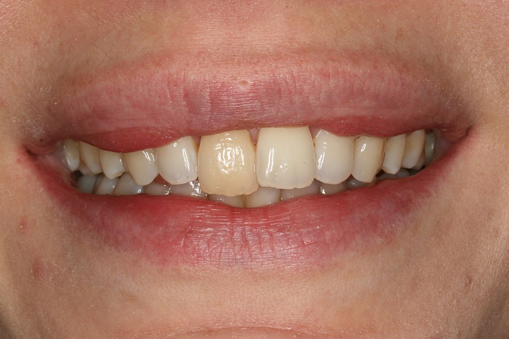 Dental Implants Before and After