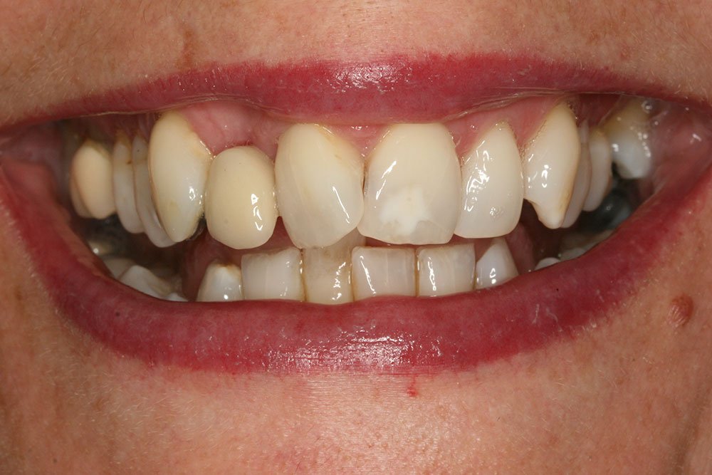 Invisalign Before and After