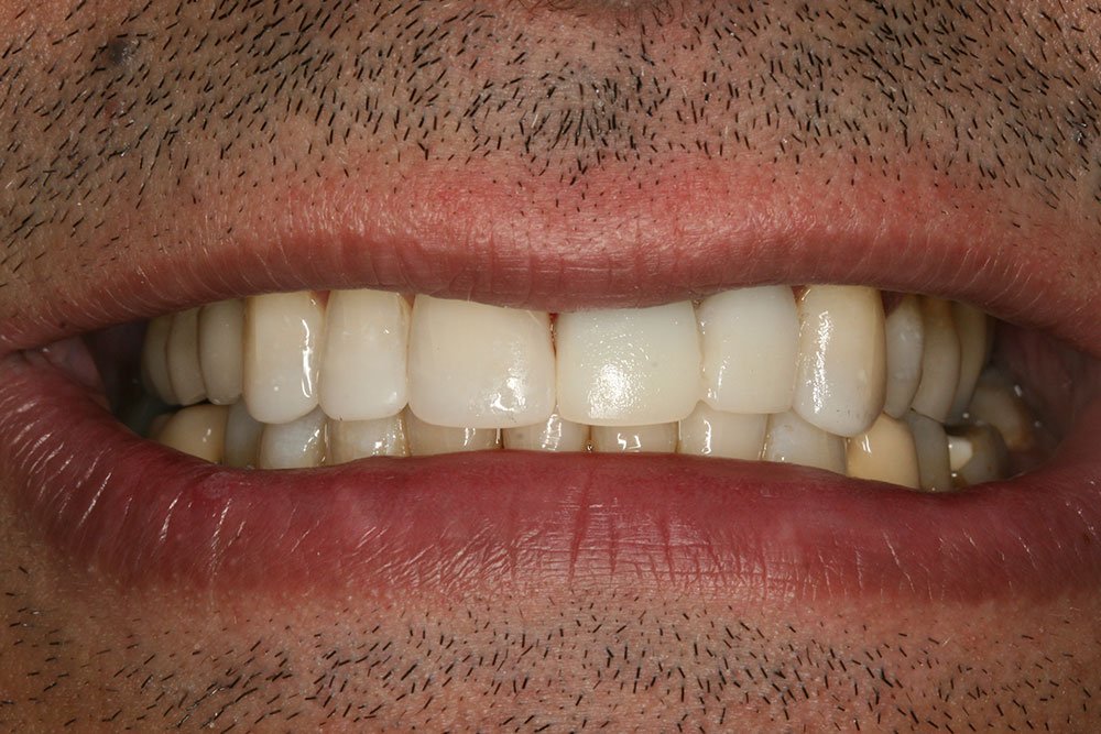 Composite Bonding Before and After