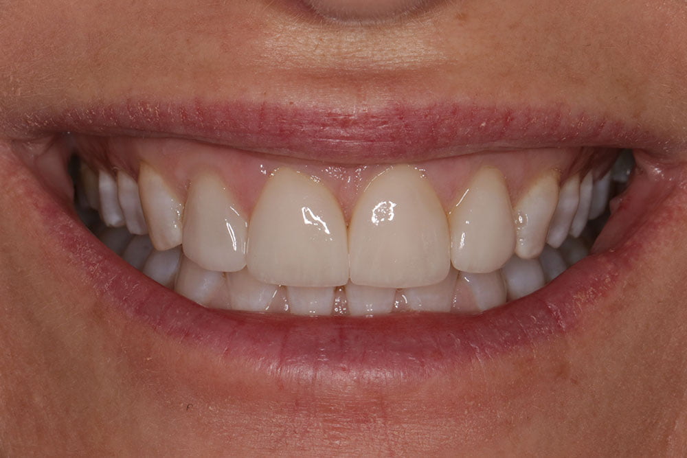 Digital Smile Design Before and After
