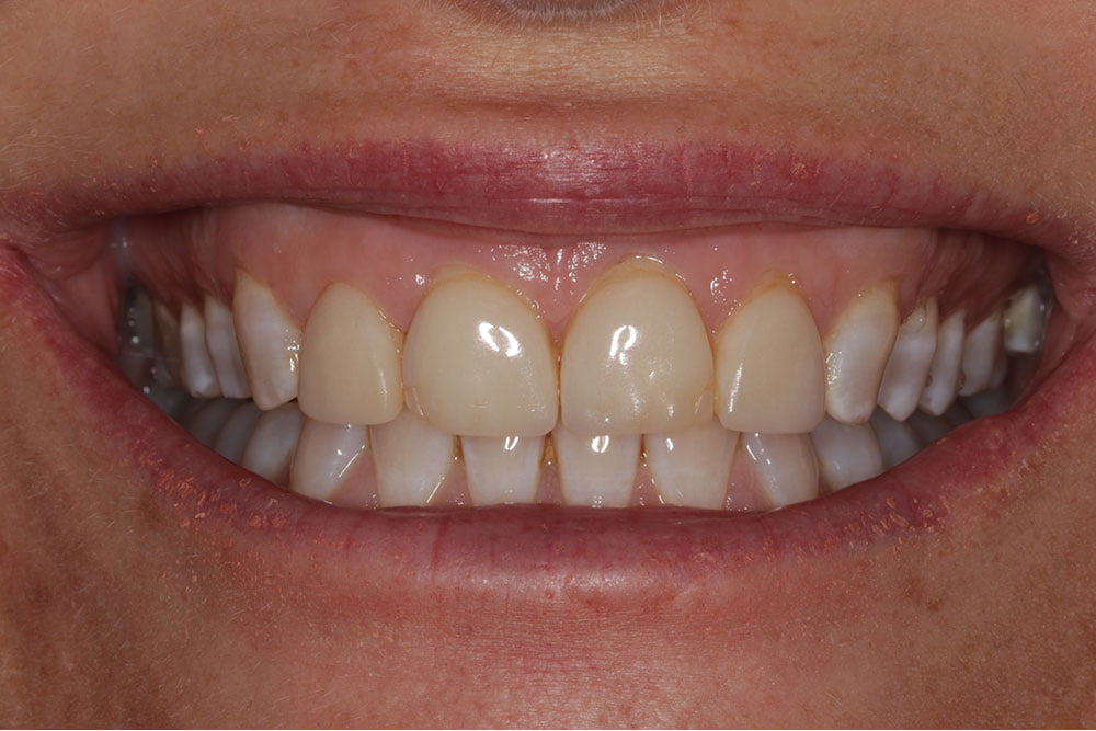 Digital Smile Design Before and After