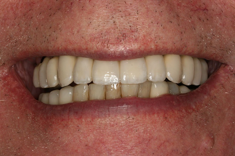 Dental Implants Before and After