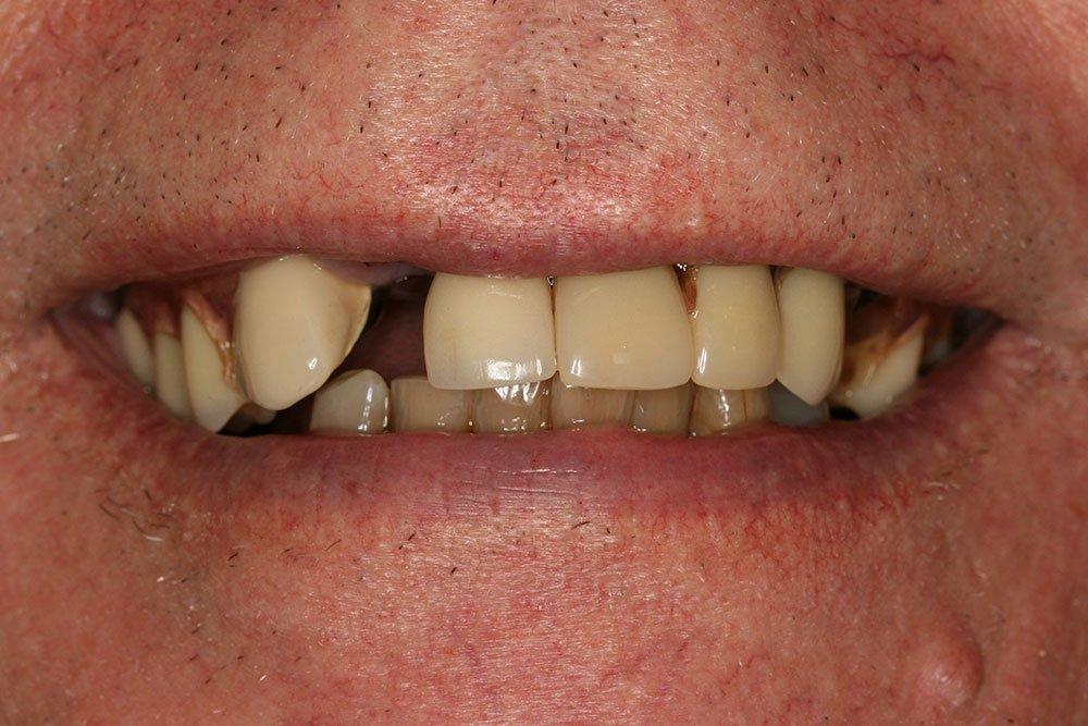 Dental Implants Before and After