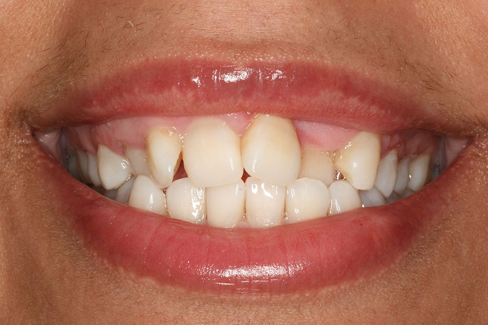 Invisalign Before and After