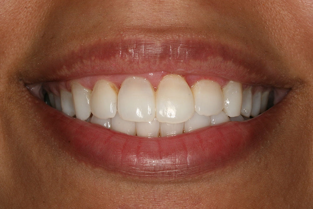 Invisalign Before and After