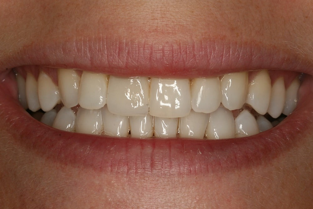 Crooked teeth veneers before and after