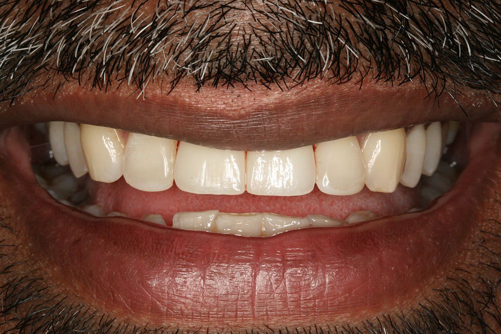 Dental Implants Before and After