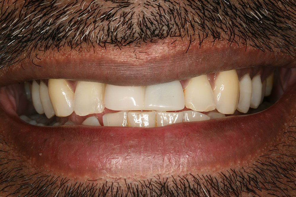 Dental Implants Before and After