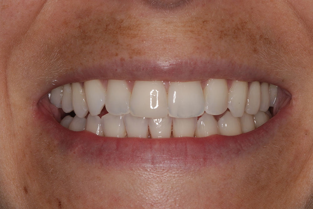 Composite Bonding Before and After