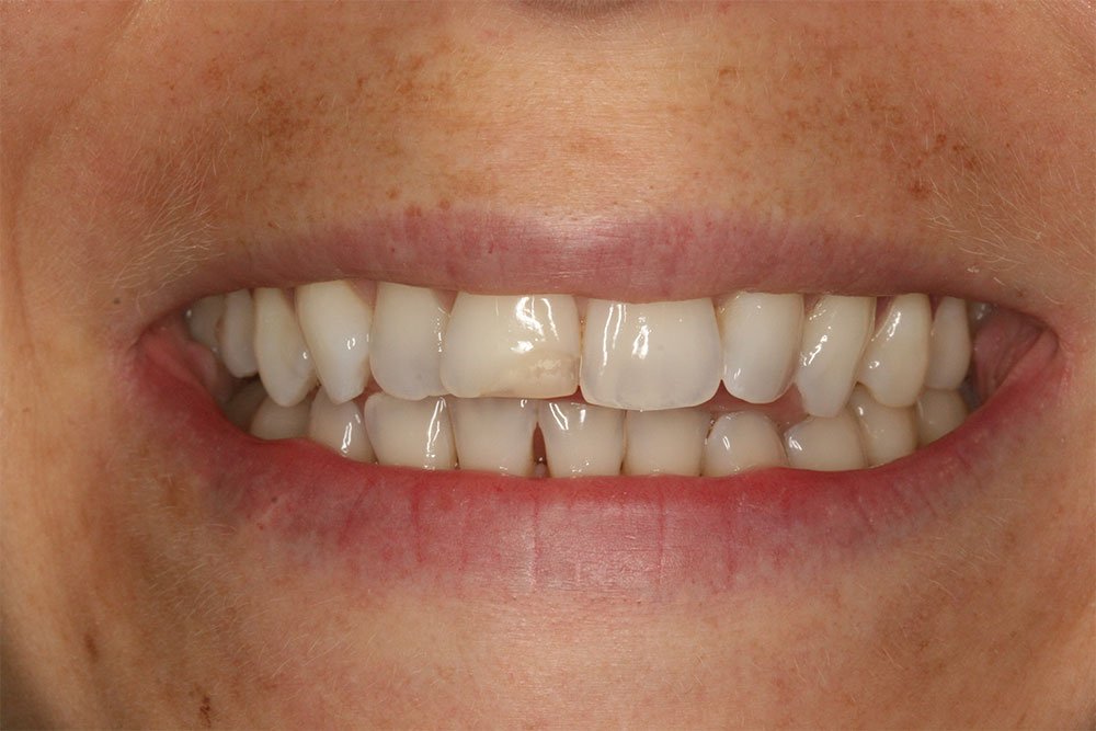 Composite Bonding Before and After