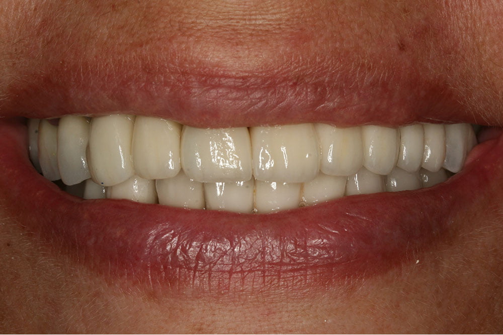 Dental Implants Before and After