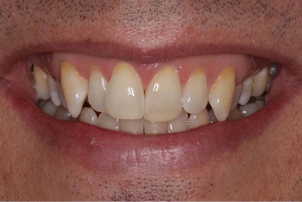 Invisalign Before and After