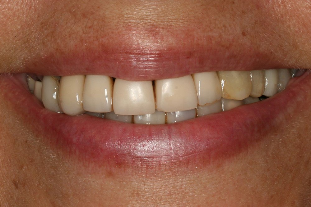 Dental Implants Before and After