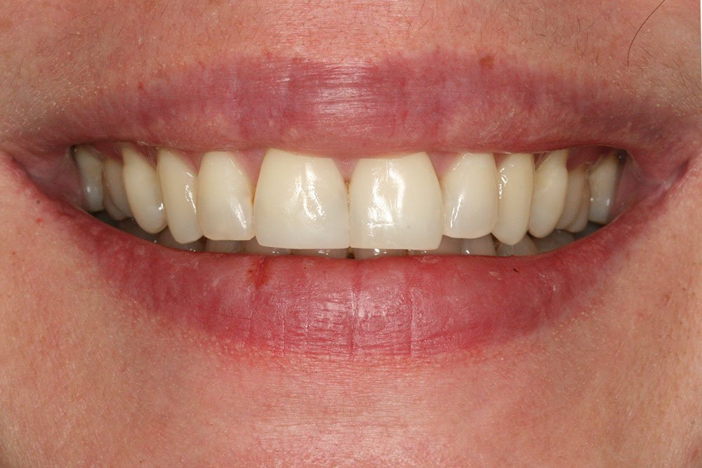 Composite Bonding Before and After