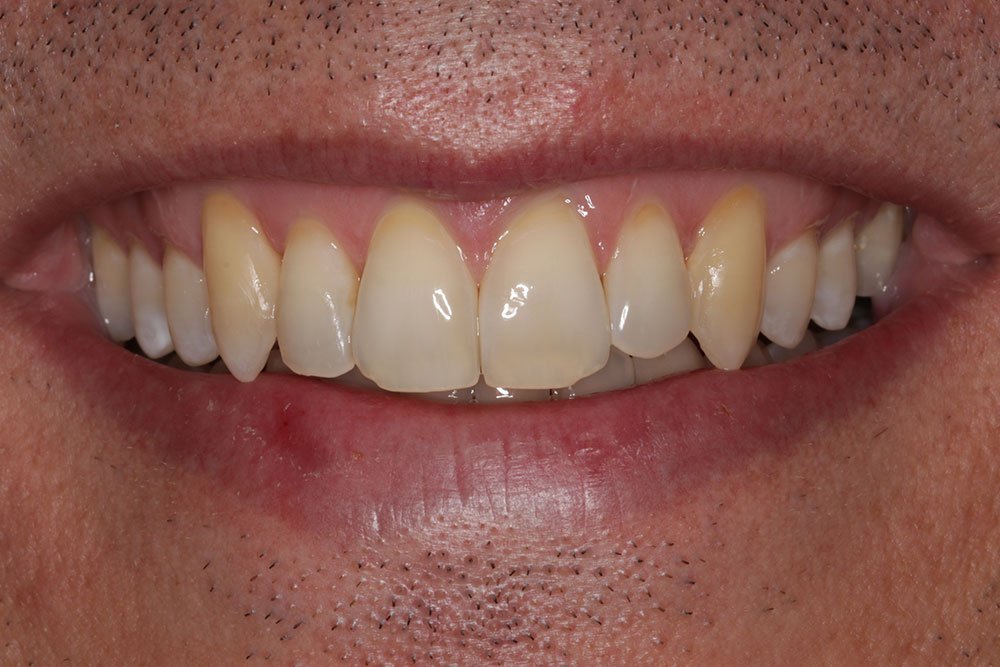 Invisalign Before and After