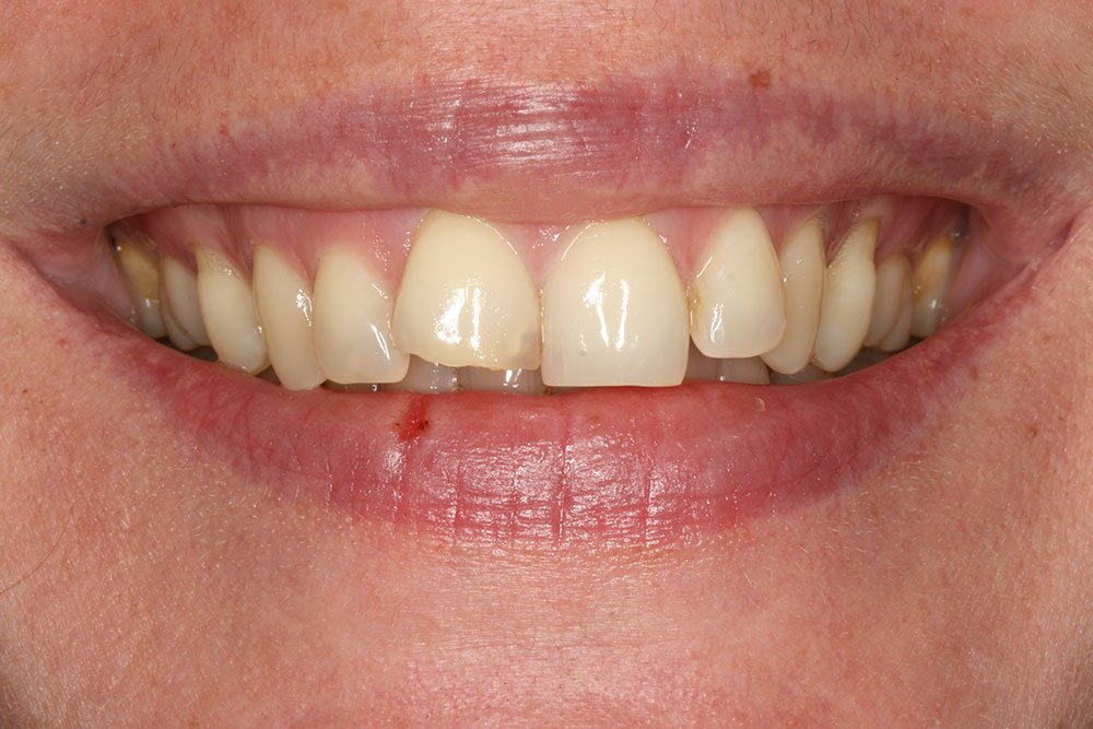 Composite Bonding Before and After