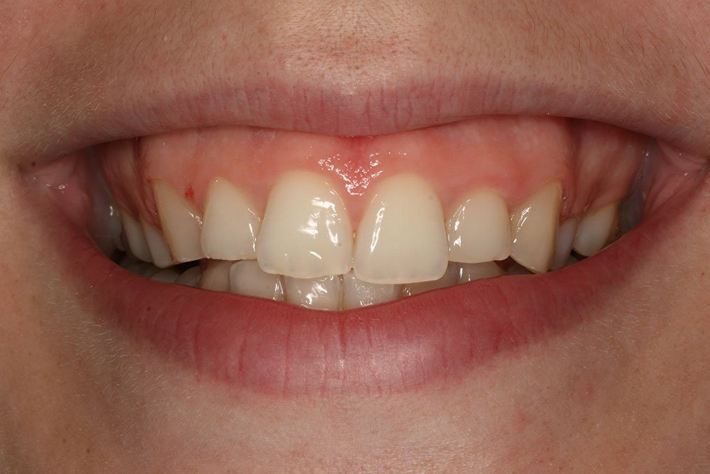 Digital Smile Design Before and After