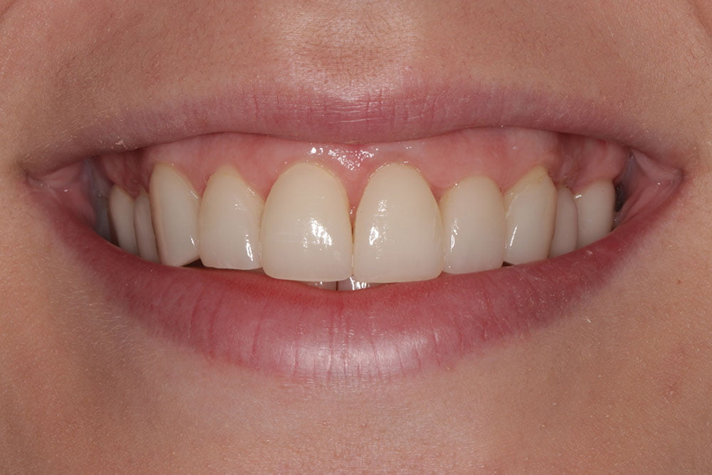 Digital Smile Design Before and After