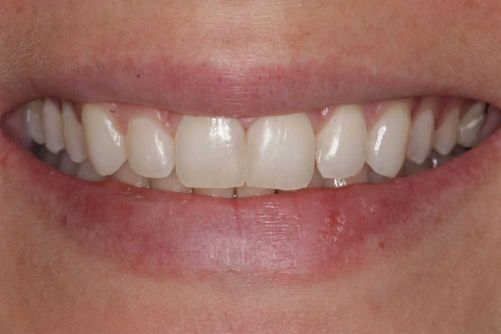 Composite Bonding Before and After