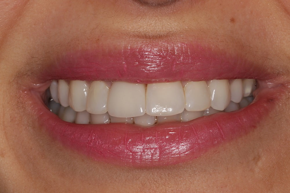 Porcelain Veneers