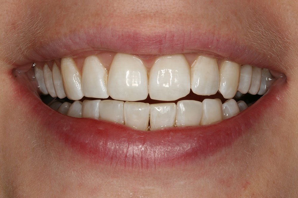 Invisalign Before and After