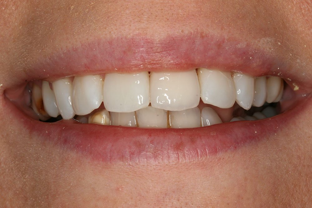 Dental Implants Before and After