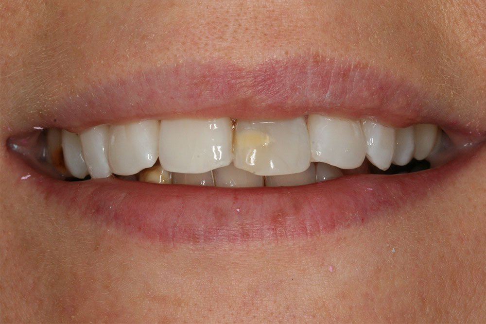 Dental Implants Before and After