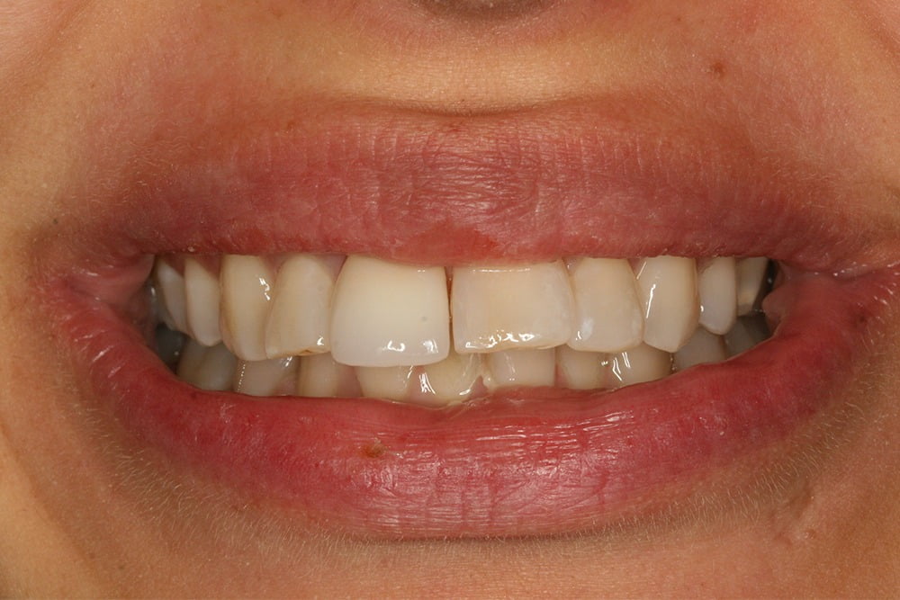 Porcelain Veneers