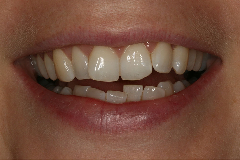 Invisalign Before and After